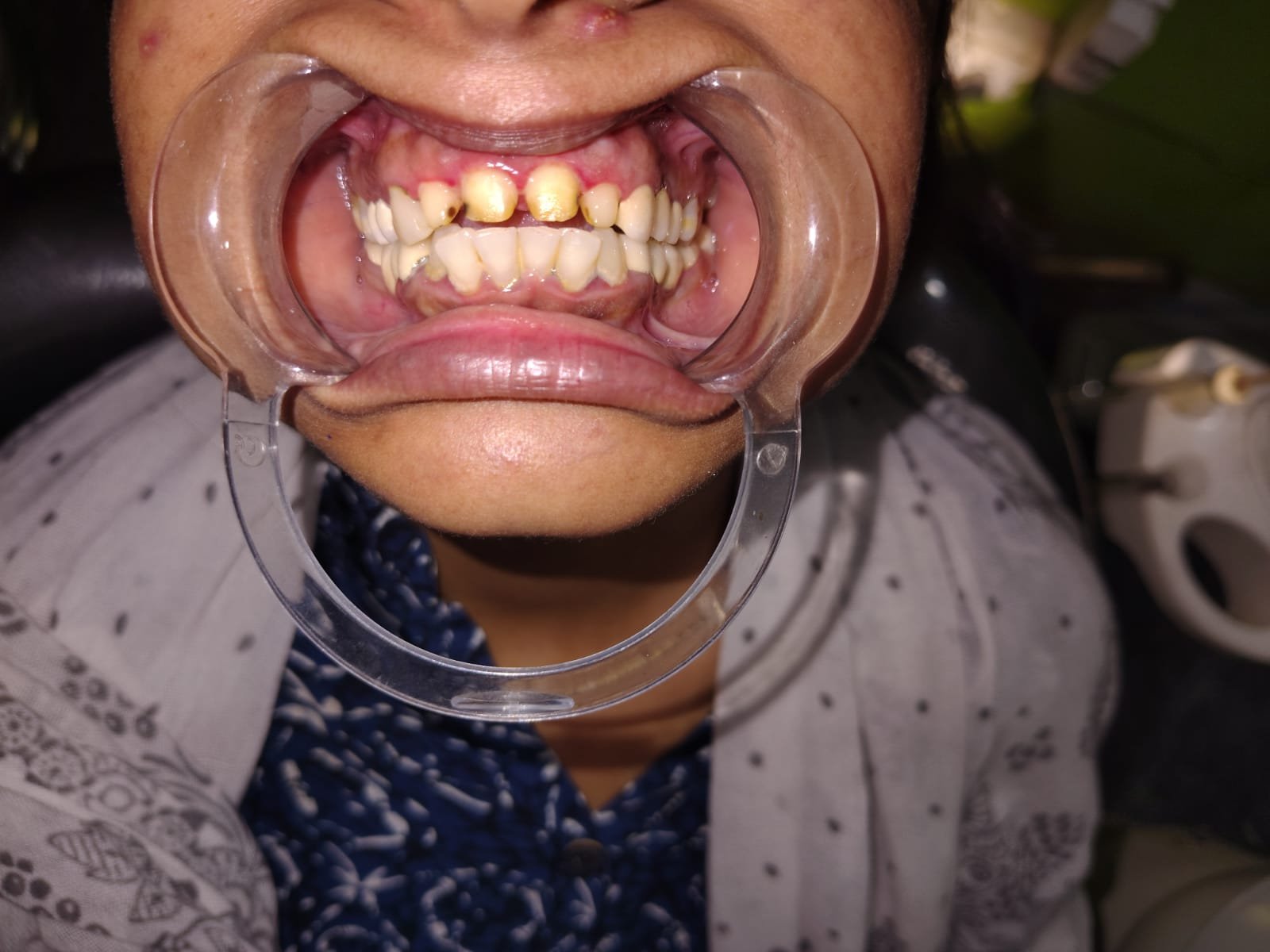 Before smile design treatment at Bhati Dental Clinic